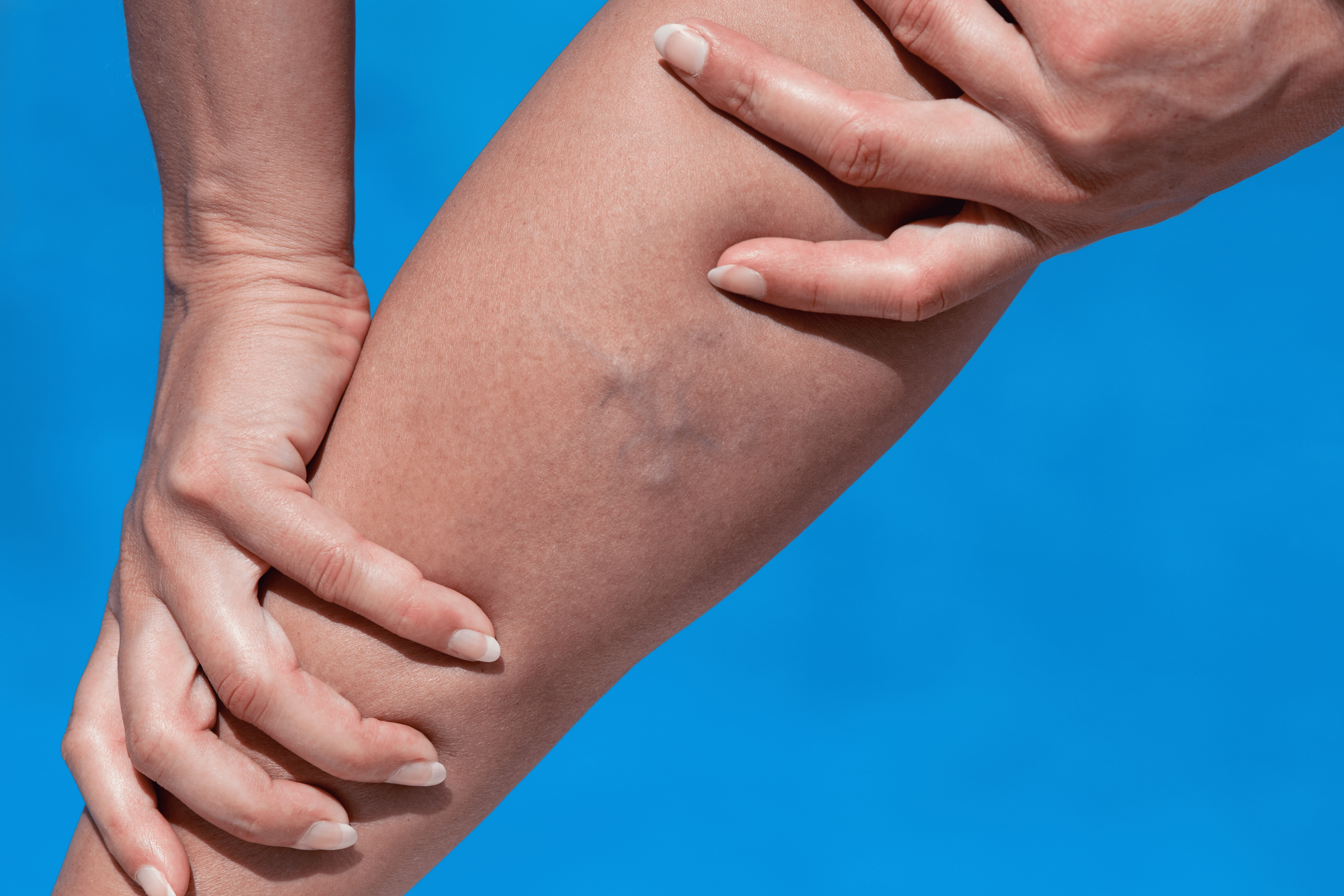 واریس و راه های درمان آن 1 vein ablation
