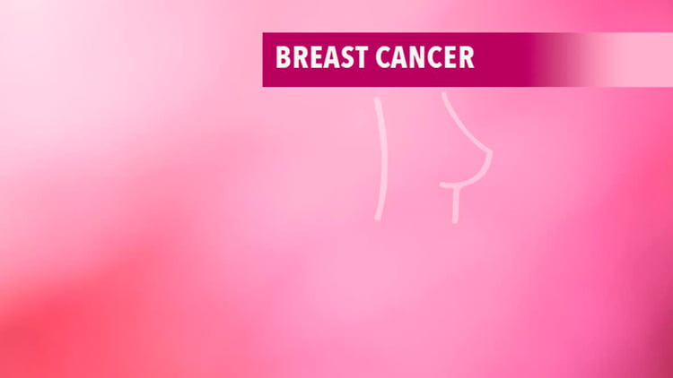 سرطان پستان، نشانه ها و تشخیص آن 1 breast cancer سرطان پستان