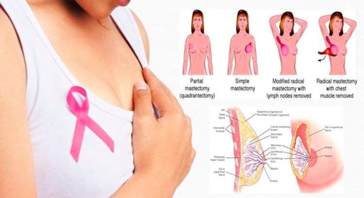 mastectomy 1 ماستکتومی و انواع آن