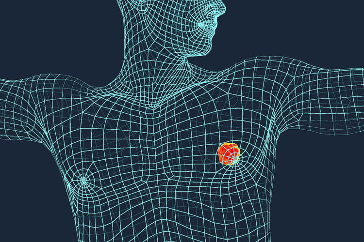 سرطان پستان در مردان 1 male breast cancer سرطان پستان در مردان