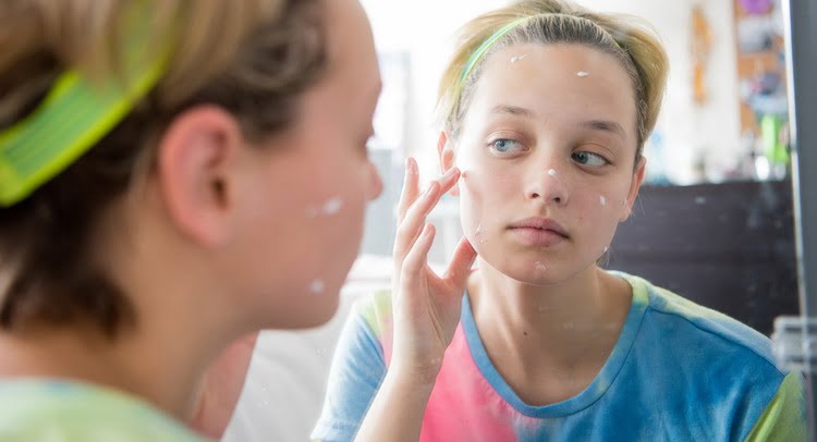 واقعیت ها و افسانه های آکنه 1 واقعیت هایی درباره آکنه