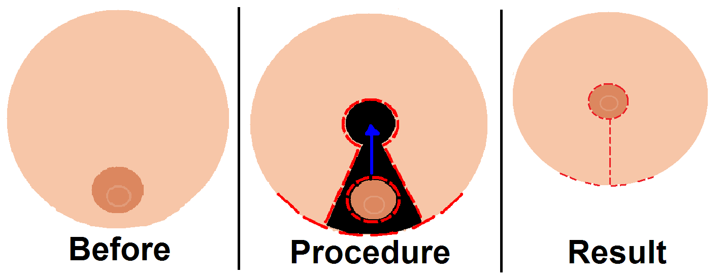 Breastreduction تکنیک های عمل ماموپلاستی