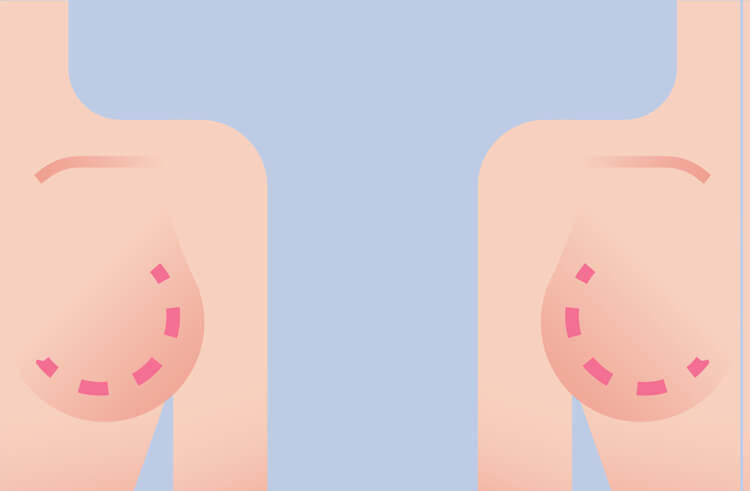 سن مناسب برای عمل ماموپلاستی 1 ServiceBreast reduction0A 1 سن مناسب برای عمل ماموپلاستی