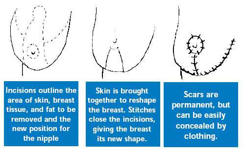 breast reduction scars تکنیک های عمل ماموپلاستی