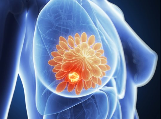 راه های درمان سرطان سینه